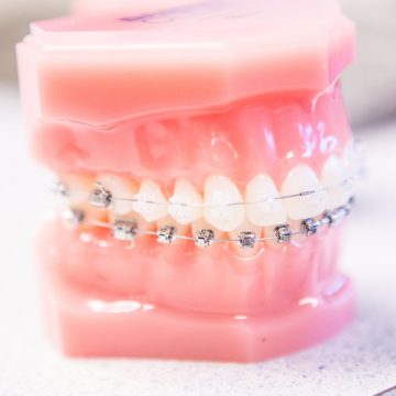 Bone Grafting: Meaning, Procedure, and Types