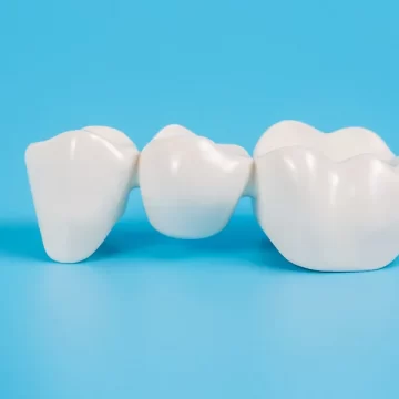 How Do You Clean A Dental Bridge?