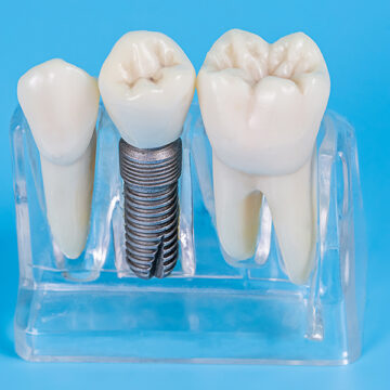 When Might a Dentist Recommend a Dental Implant Restoration?