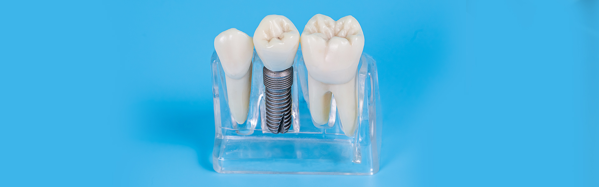 When Might a Dentist Recommend a Dental Implant Restoration?