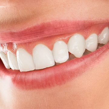 Do Teeth Keep Getting Whiter After Zoom?
