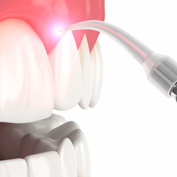5 Reasons to Choose Laser Gum Surgery for Treating Periodontal Disease