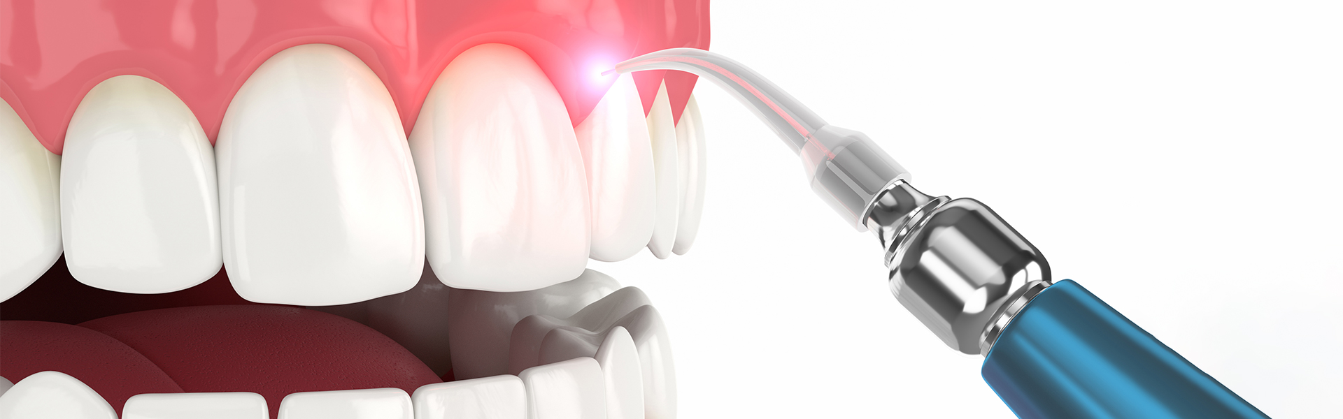 5 Reasons to Choose Laser Gum Surgery for Treating Periodontal Disease